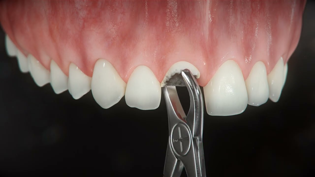 Implantes inmediatos Straumann en Logroño