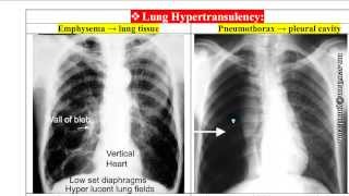 شرح أشعة الصدر Chest x-Rays د. محمود سويلم