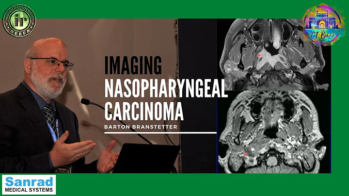 NASOPHARYNGEAL CARCINOMA IMAGING | DR BARTON BRANS...