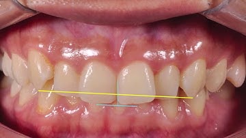 DIGITAL SMILE DESIGN   DSD FABIOLA   SOLA PERU