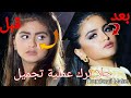 حلا ترك عملية تجميل Hala Turk Nose Surgery