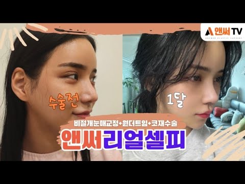 눈코수술 (비절개눈매교정+원더트임+코재수술) 1달 후기 l 앤써성형외과 Answer Plastic Surgery