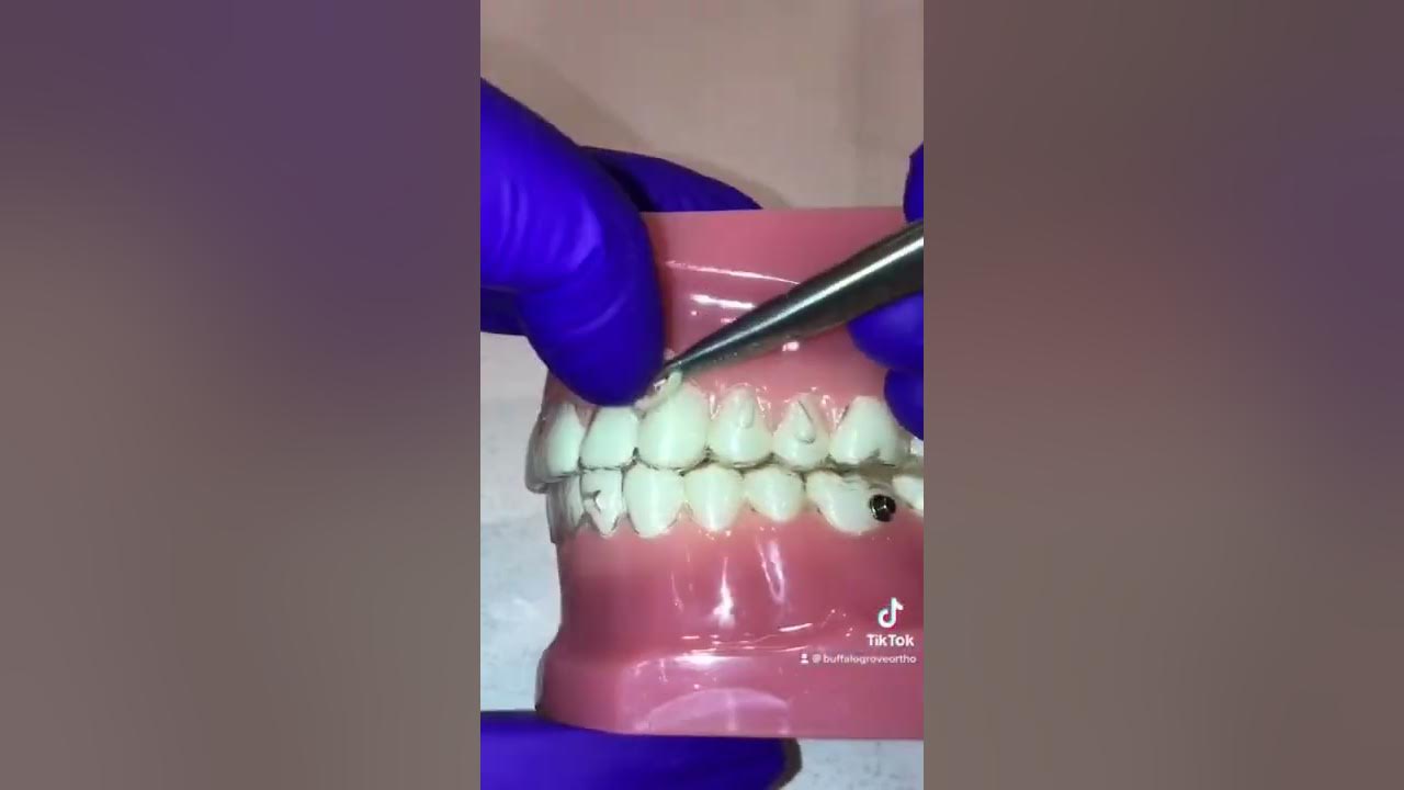 Using rubber bands with Invisalign aligners YouTube