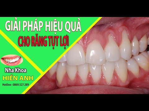 cách chăm sóc răng bị tụt lợi tại Kemtrinam.vn