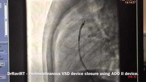 DrRaviRT - Perimembranous VSD Device closure using ADO II device