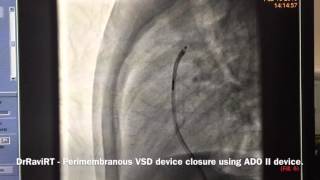 DrRaviRT - Perimembranous VSD Device closure using ADO II device