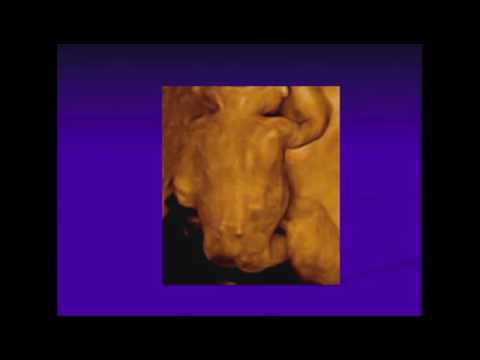 Prenatal Diagnosis of Skeletal Abnormalities