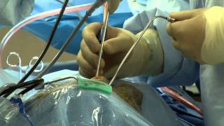 Doctors Perform Brain Surgery...through The Nose