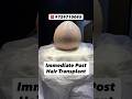 Front to Back High Density Hair Transplant | Immediate Post Result #shorts #hairtransplant #hair