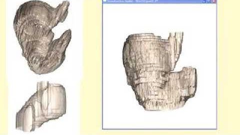 eScience: Simulation and Modeling - Development of a 3D Stomach Model for Surgical Planning