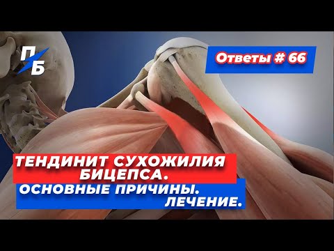 Тендинит сухожилия бицепса. Основные причины. Лечение. Ответы 66