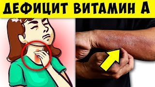 9 отчаянных признаков Дефицита витамина А, которые вы не должны игнорировать! Что Делать