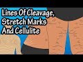 Also Lines Of Cleavage Stretch Marks And Cellulite - What Is Cellulite - What Are Stretch Marks