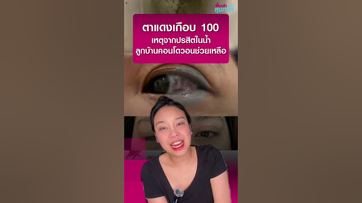 "ตาแดง"จากปรสิตในน้ำเกือบ 100 ราย ลูกบ้านคอนโดหรูวอนขอความช่วยเหลือ l เล่าข่าวสุขภาพ