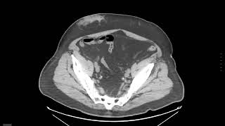 Abdominal Case Conference 2025 - Session 22