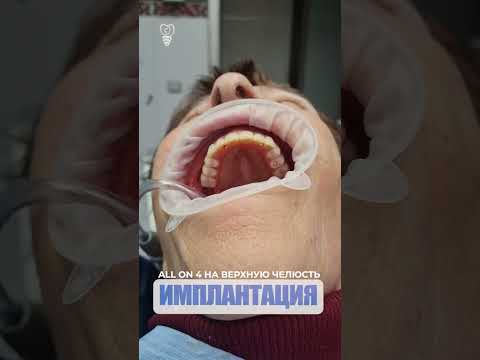 All on 4 на верхнюю челюсть. All on 4 on the upper jaw. Implantation.