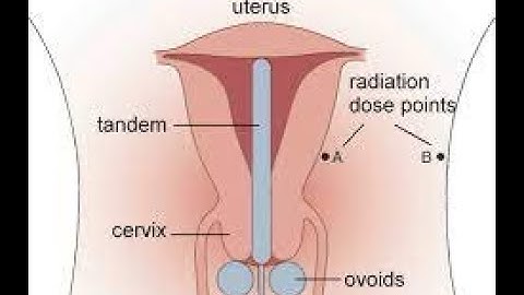 Insertion of uterine tandem CPT code - simplify medical coding