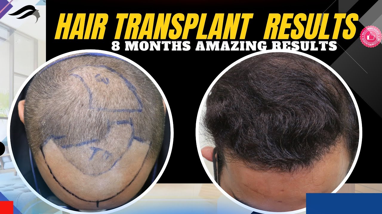 Hair Transplant In Madurai Best Clinic Surgeon Results & Cost Of Hair