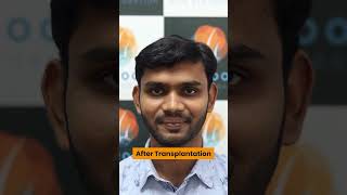 Real Hair Transplant Results @alloroots