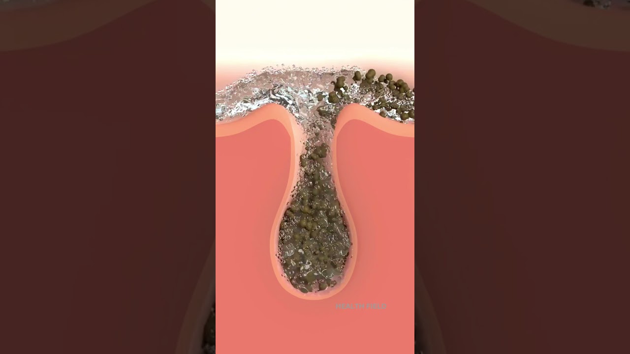 This is how clogged Hair follicle get cleaned with disinfectant spray 🧑‍⚕️