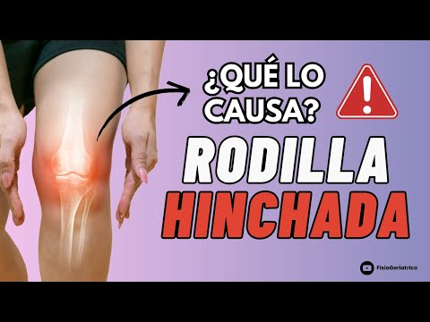 Si tu rodilla está Hinchada, ¡Fíjate en esto!