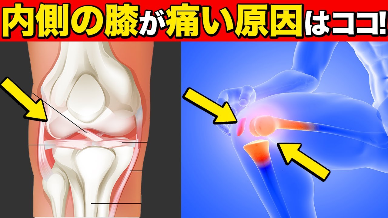 【膝の内側が痛む】最新研究!!99%が知らない膝の痛みの原因【現役医師解説】 - YouTube