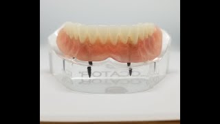 Lower denture implants