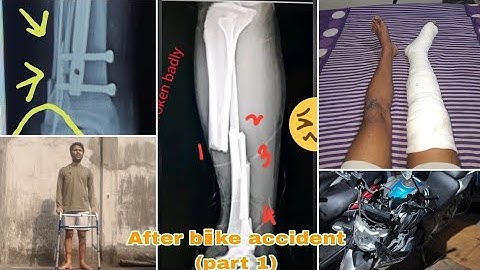 #Episode 1 Broken leg full recovery  update #tibea and fibula broken