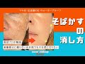 【現役プロ版】画像修正無し　そばかす消し方①