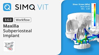 Simq VIT 3.6.0 - Maxillary Subperiosteal Implant