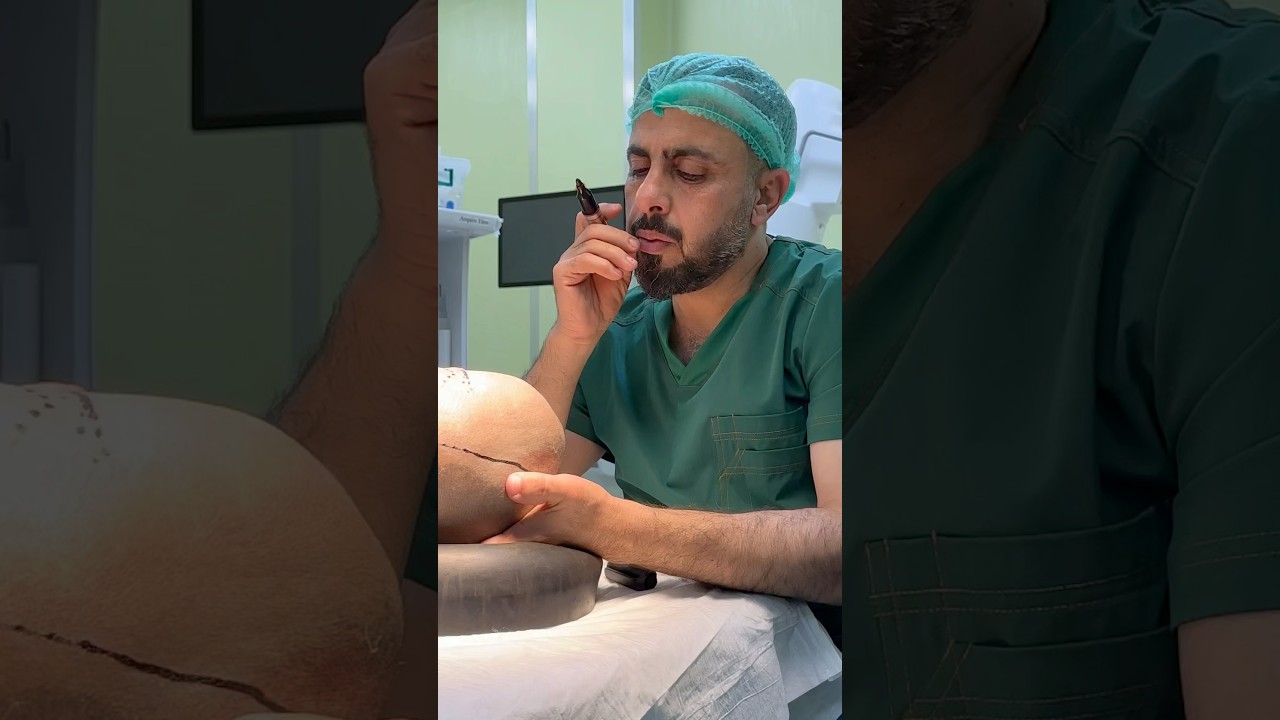 عملية تجميل الجمجمة .عملية نوعية استغرقت اكثر من 8ساعات متواصله .. #تثبيت_الفقرات #دويتو