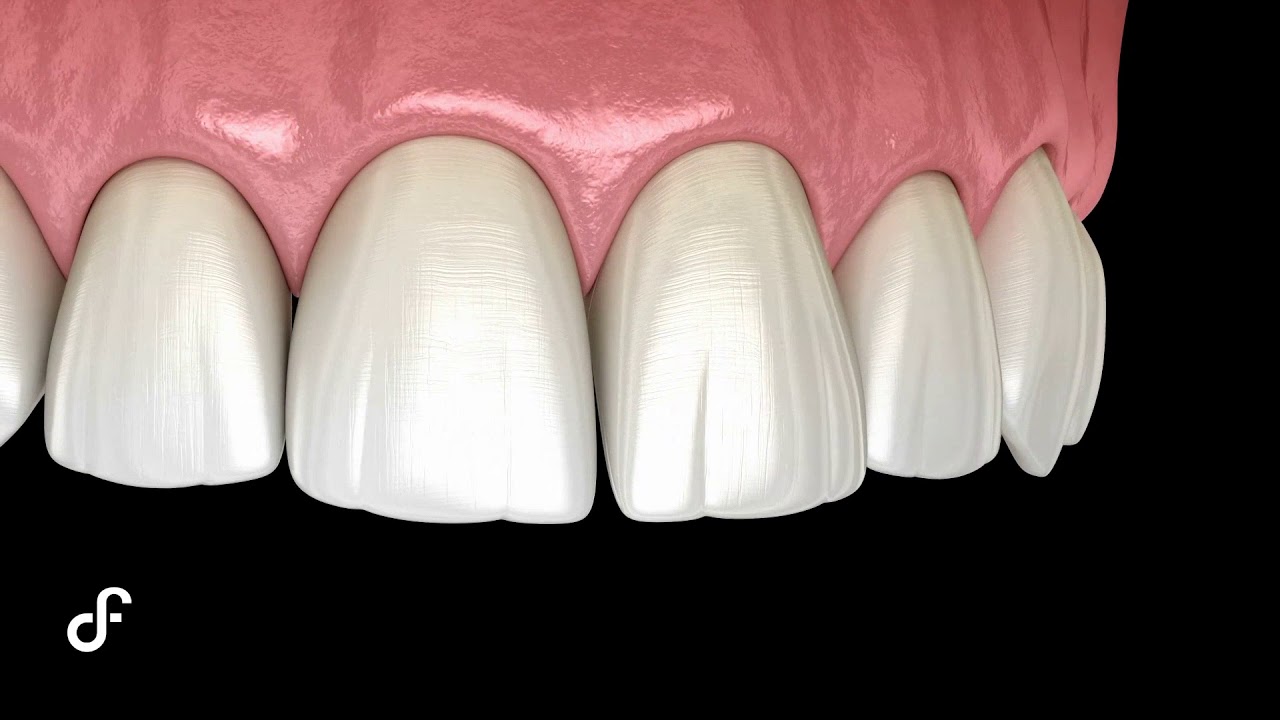 Veneer (single) | DF Premium | Dental Focus Websites