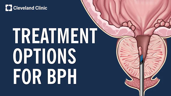 Treating Benign Prostatic Hyperplasia (BPH) - DayDayNews