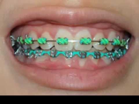 What Are Lingual Braces? - ArchWired