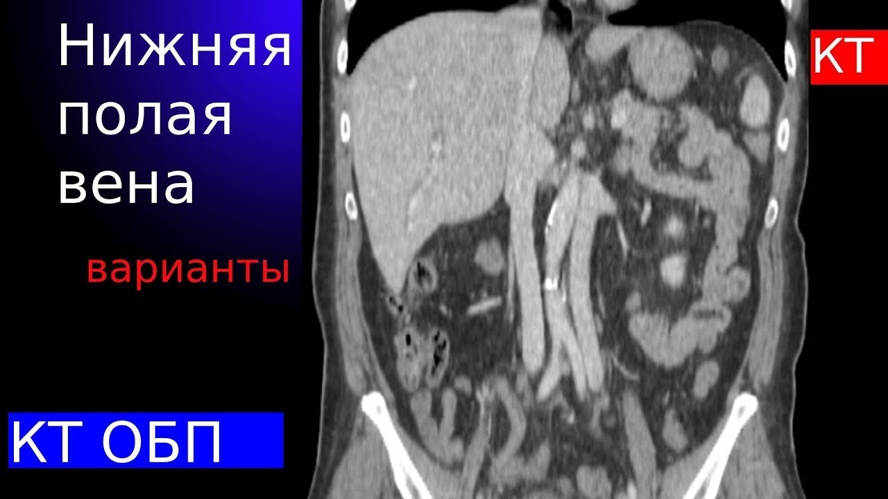Нижняя полая вена и ее вариант на КТ - YouTube