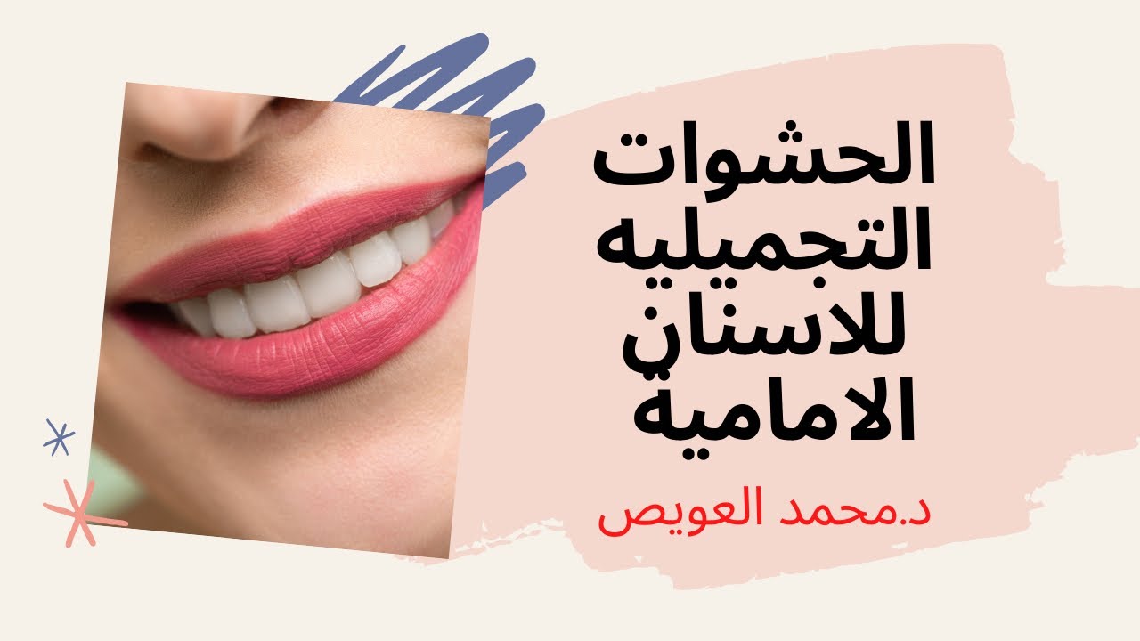 حشوة تجميلية للاسنان الامامية ✅حشوة بيضاء