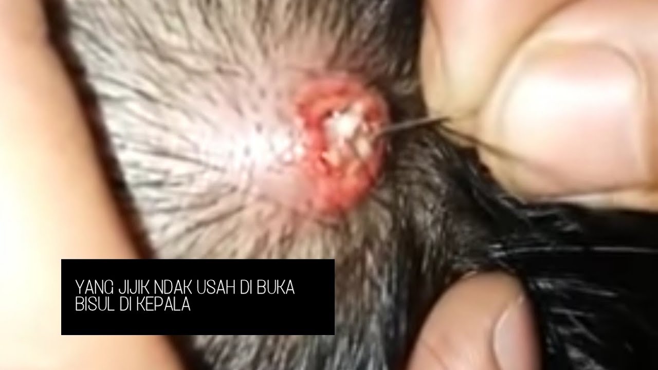 Bisul Di Kepala Yang Menjijikkan Youtube