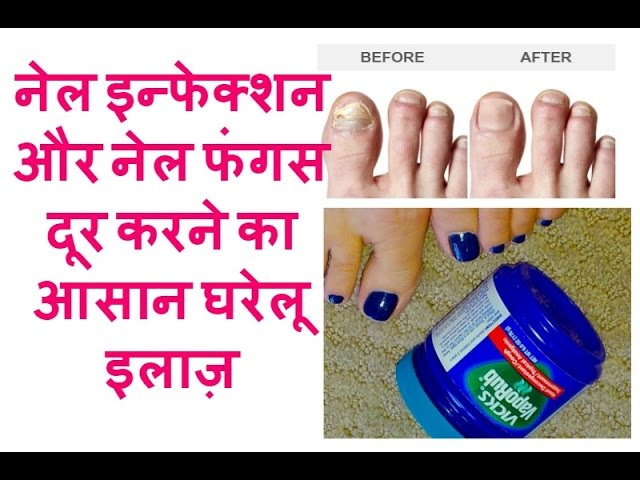 फंगल इन्फेक्शन के आयुर्वेदिक उपाय - Ayurvedic remedies for Fungal  Infections in Hindi