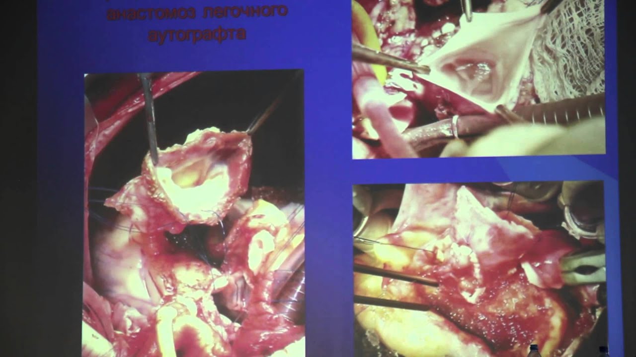Операция Росса у детей