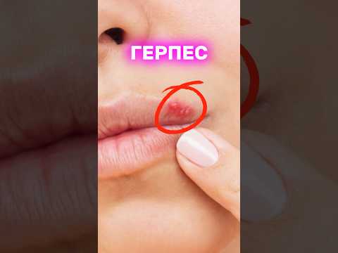 Ты не знал ЭТО про ГЕРПЕС. Как лечить? Можно ли выдавливать?