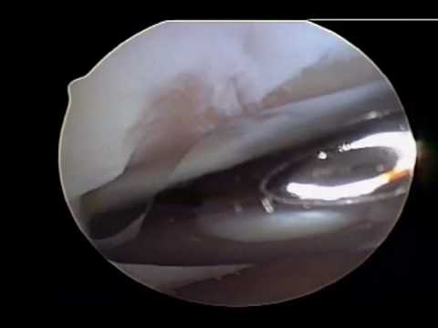 Chondroplasty - Cartilage Knee Surgery by Dr. Stev...