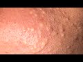 Black heads remove