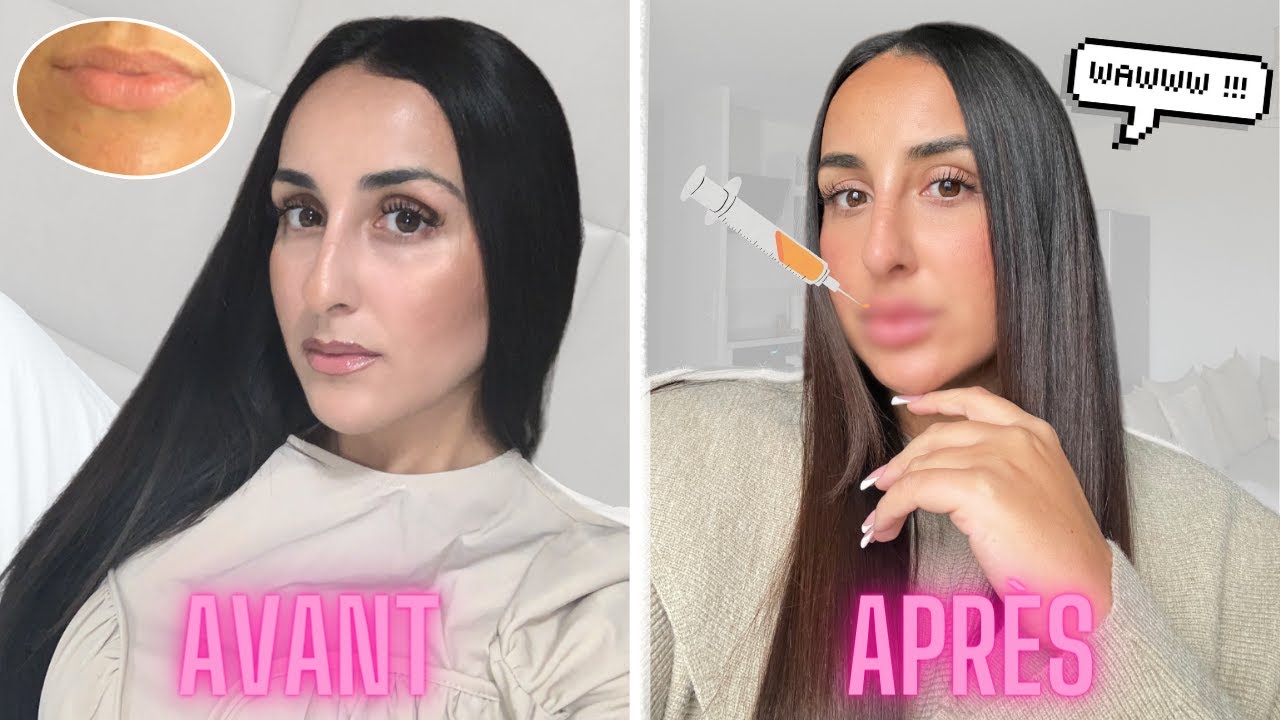 JE REFAIS MES LÈVRES | je vous dis tout sur mes injections 👄💉