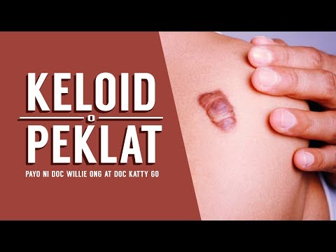 PEKLAT: Lunas sa Keloid - ni Dr Katty Go (Dermatologist) #29b
