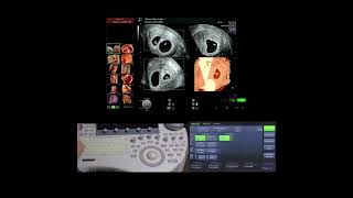 Establish a new level of 3D/4D imaging with Voluson™ HDlive