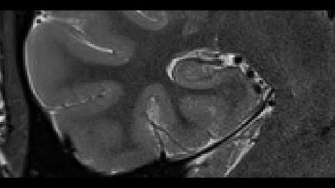 Hippocampal Segmentation