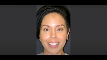 How Bioclear Uveneers give you a smile without grinding. Don’t do porcelain veneers!, Podcast 12