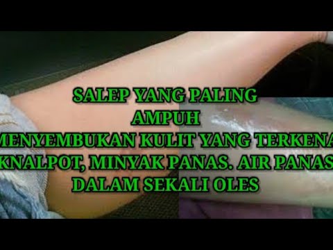 SALEP LUKA BAKAR TERKENA KENALPOT, MINYAK PANAS YANG AMPUH ...