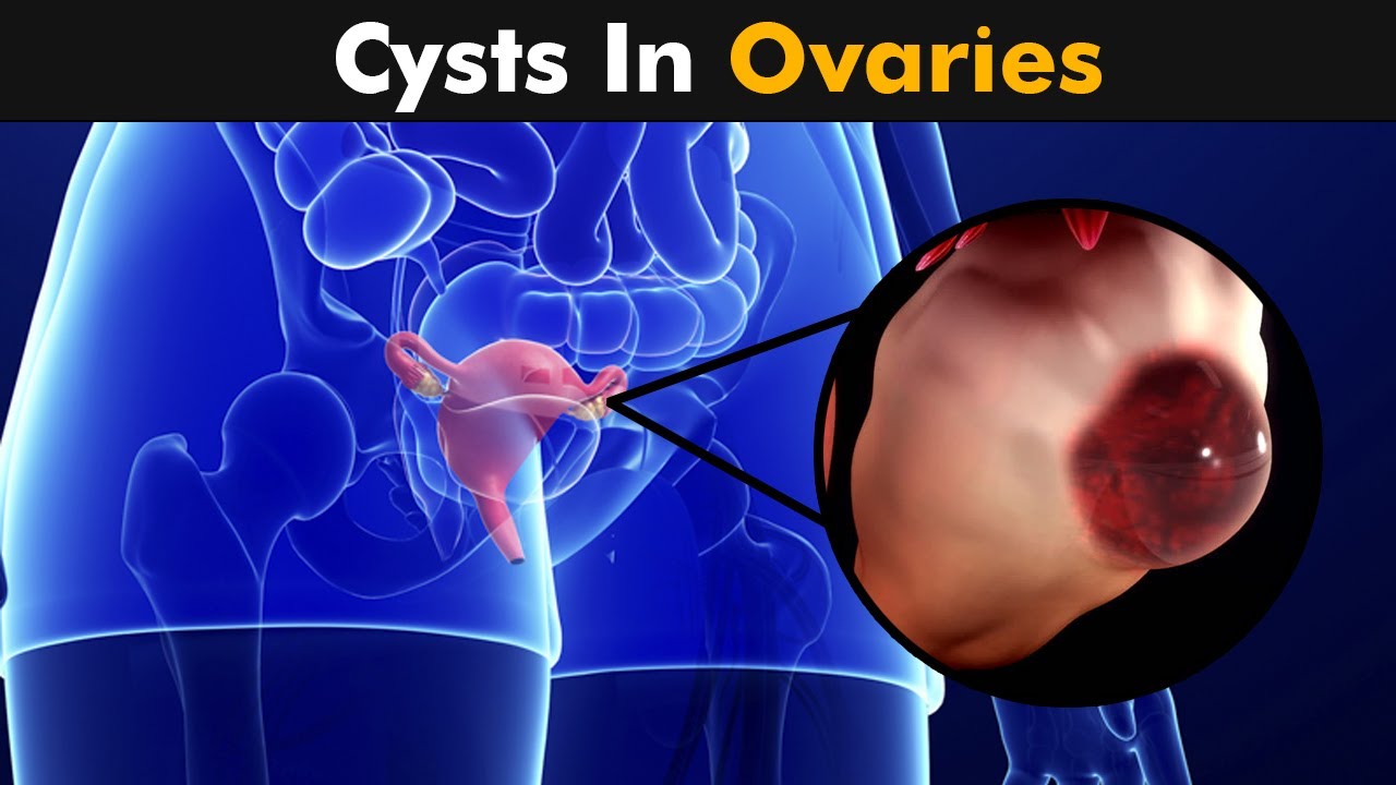 Ovarian cyst symptoms