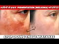 लड़कियों  को  झाइयां  Pigmentation (Melasma) क्यों  होती  है? Stop doing these Mistakes.